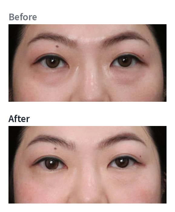 Eye area — BTL EXION Face