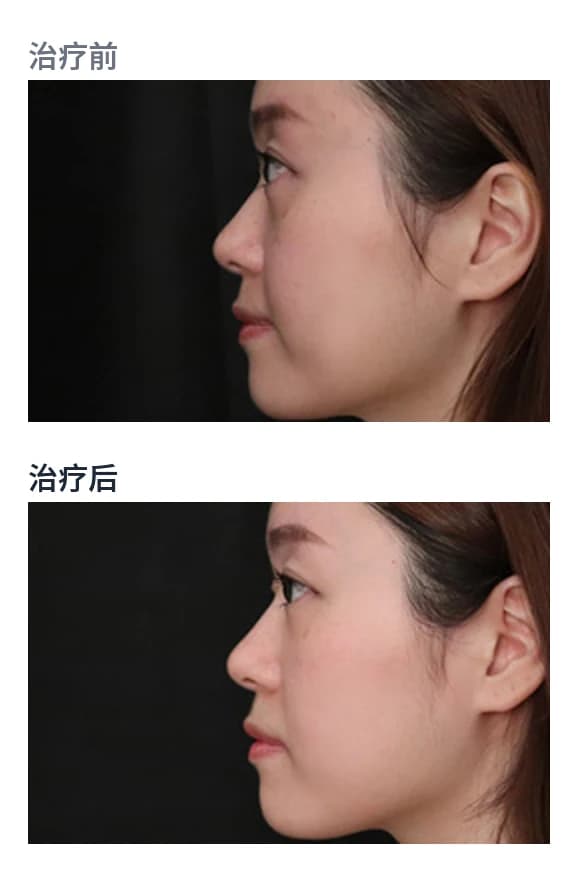 眼周 — BTL EXION Face